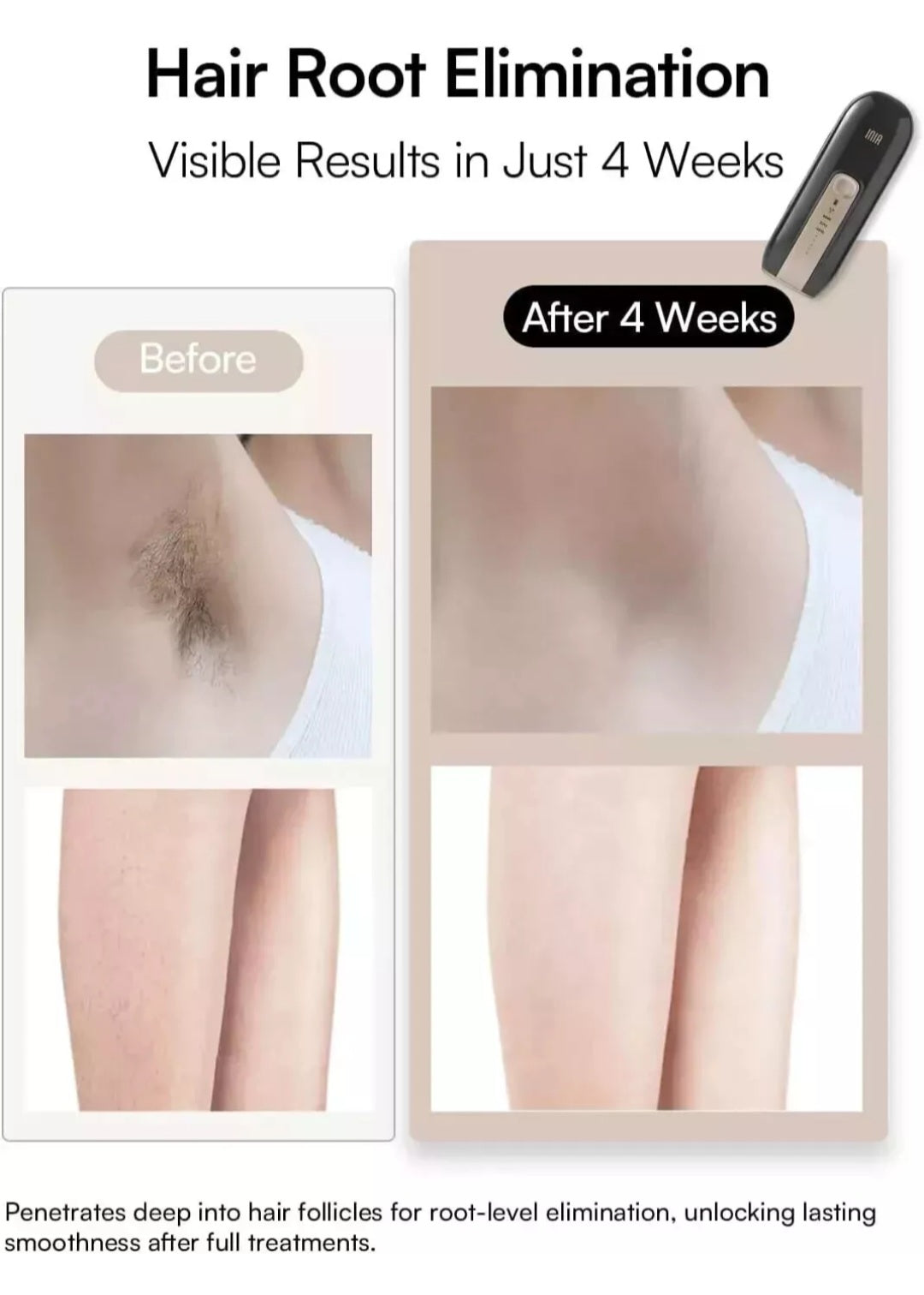 INIA Laser Hair Removal Device